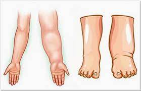 Linfedema.