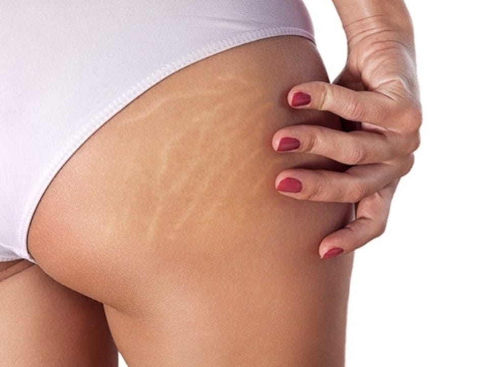 Intradermoterapia para estrias.