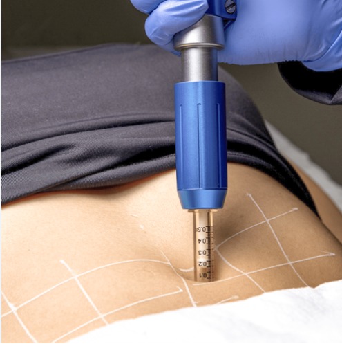 Intradermoterapia para gordura localizada..