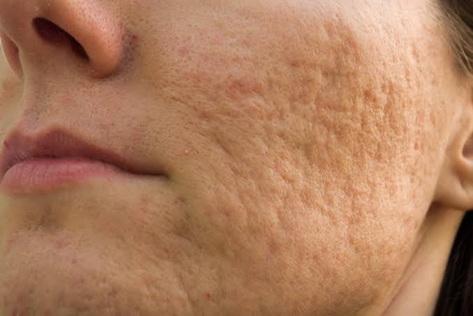 Cicatrizes de acne.