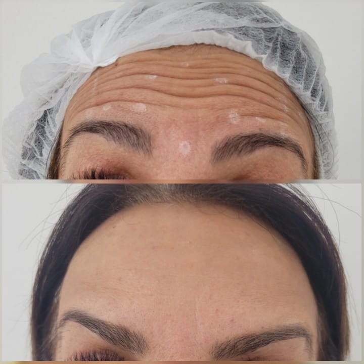  Biorevitalização das mãos com ácido hialurônico