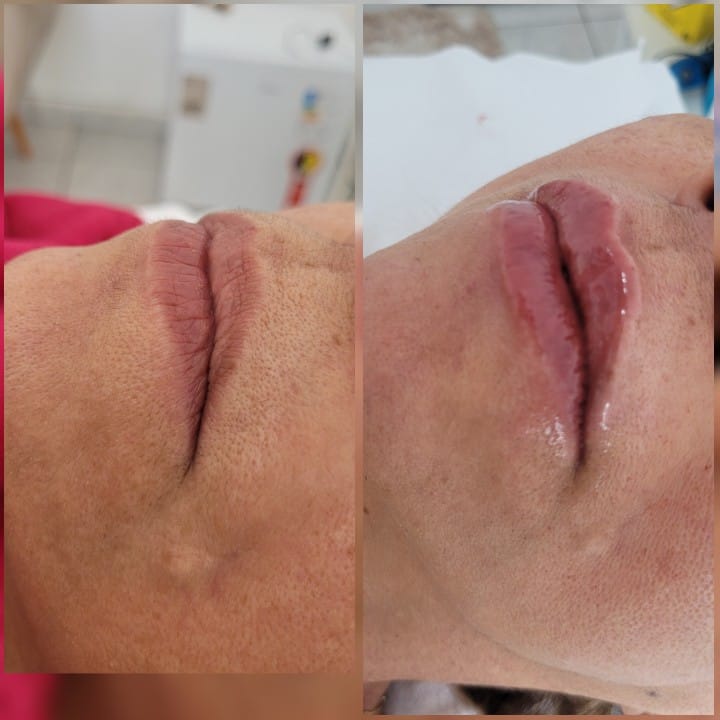 Cicatrizes de acne.