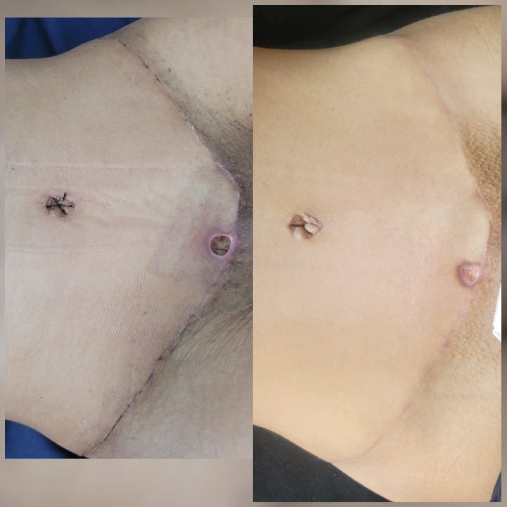 Pós - Operatório Mamoplastia de Aumento