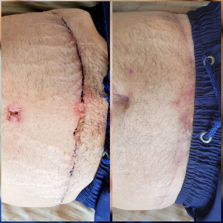 Pós - Operatório Mamoplastia de Aumento