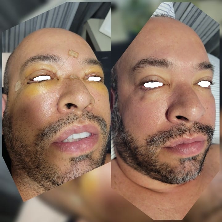 Bleforoplastia