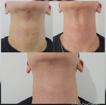 Lipo Papada
