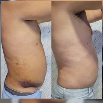 Lipo Aspiração