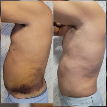 Lipo Aspiração