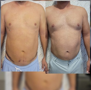 Lipo Aspiração