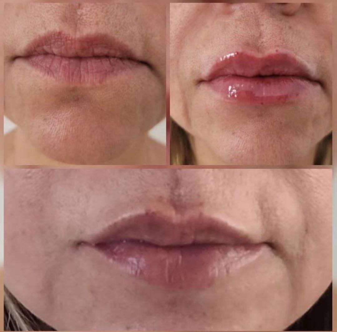 Preenchimento Labial
