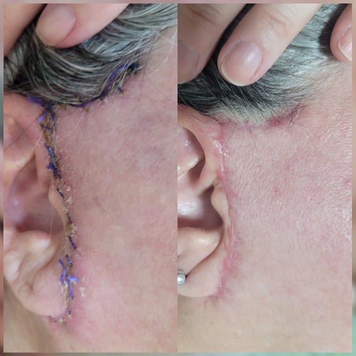Pos Operatorio de Ritidoplastia