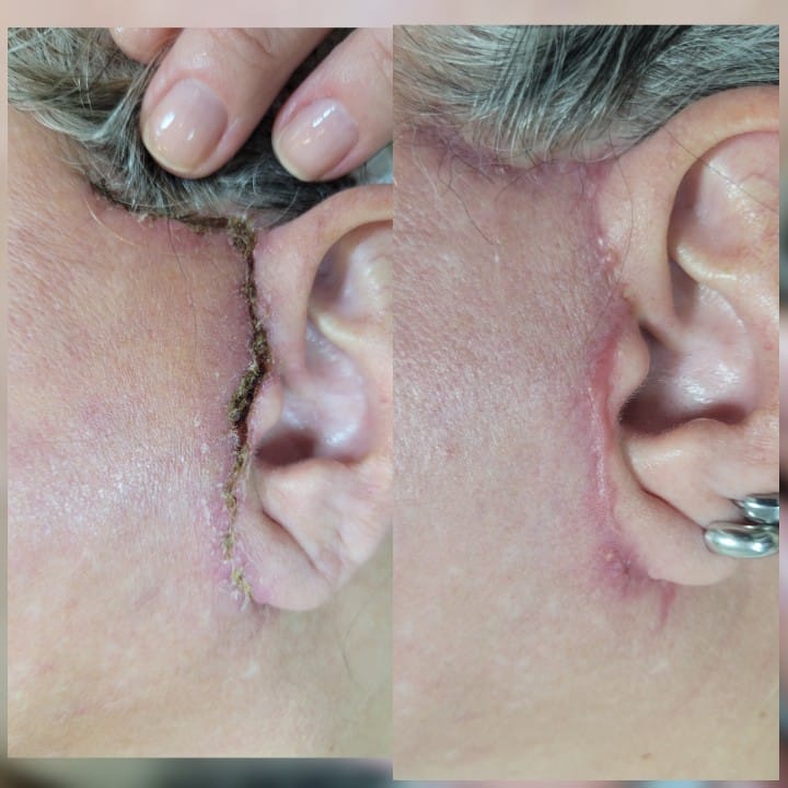 Pos Operatorio de Ritidoplastia